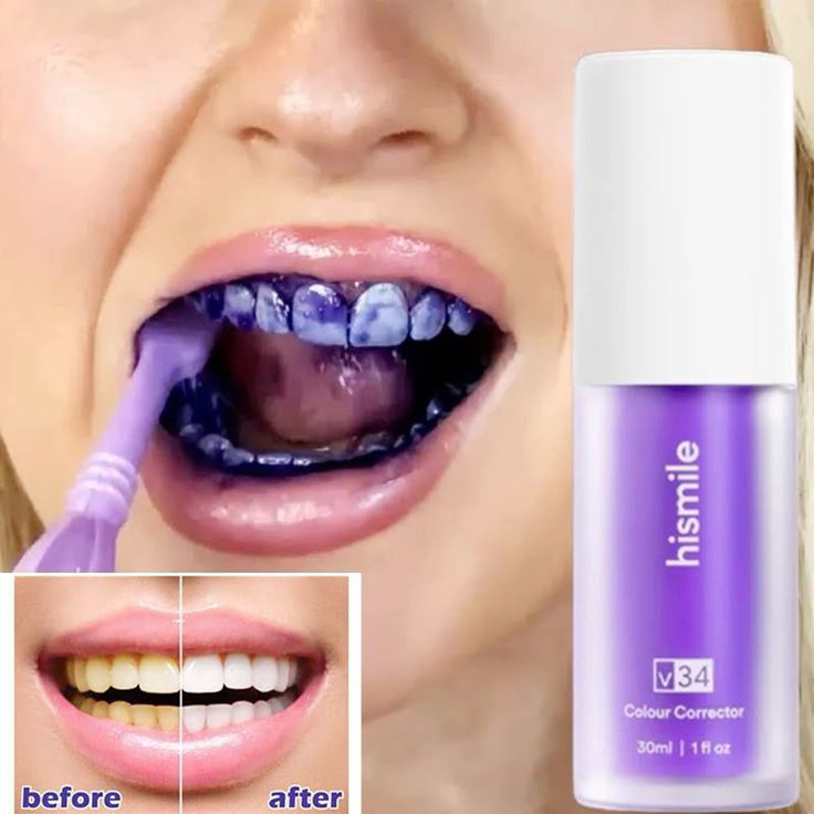 Teeth Whitening