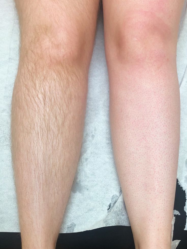 Hair Removal Spray Foam